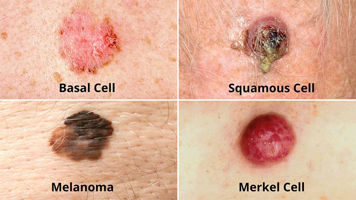 Benefits of Sun Hats Benefits of Sun Hats